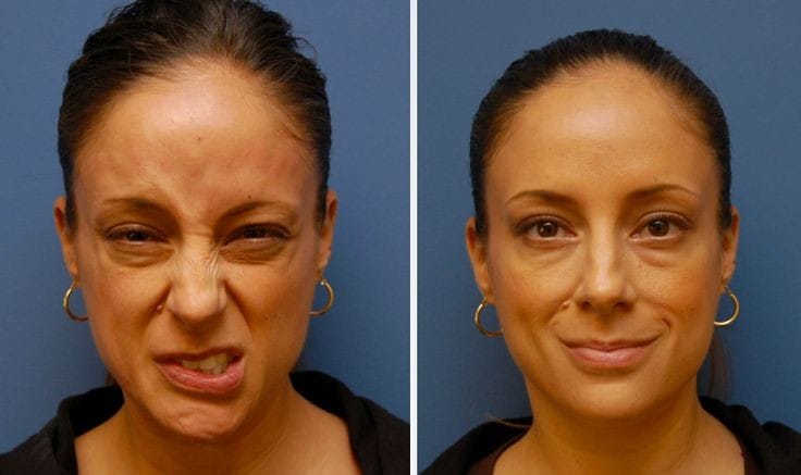 What is Facial Paralysis (Bell's Palsy), Causes, Symptoms, Treatments & More