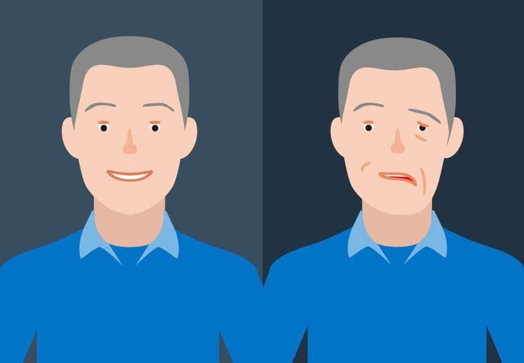 What is Facial Paralysis (Bell's Palsy), Causes, Symptoms, Treatments & More